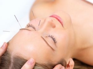 A lady receiving Acupuncture